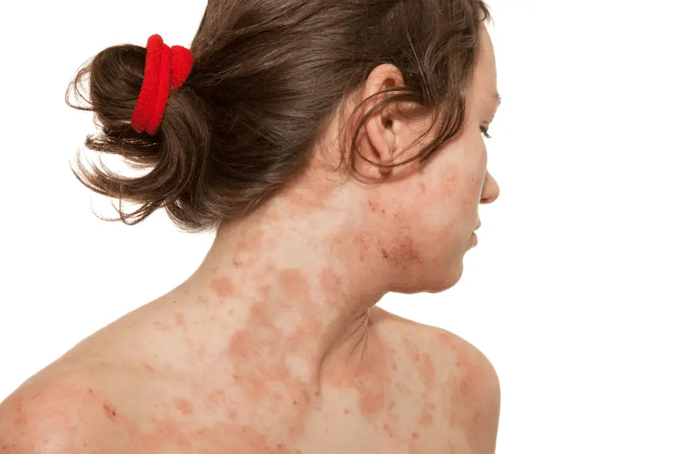 What Is Dermatitis? Types, Causes, and How to Manage Flare-Ups