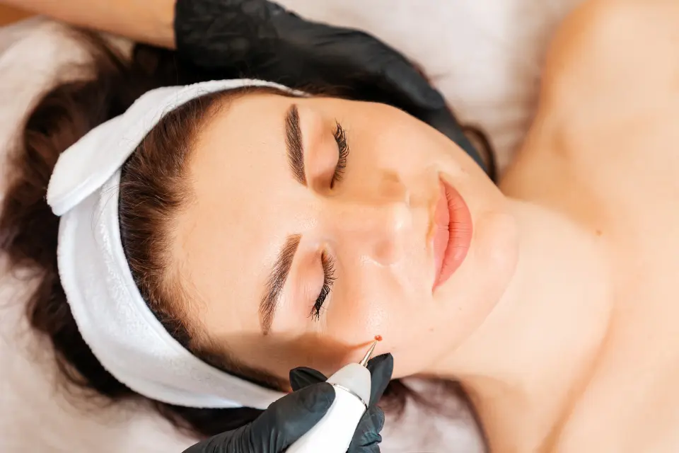 Laser Mole Removal: Is It Right for You?