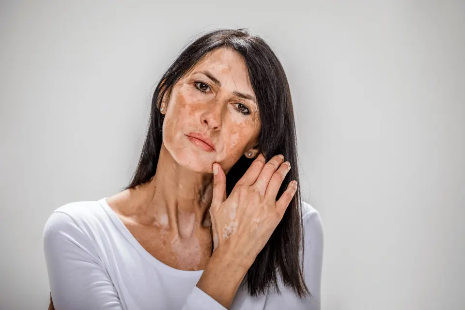 White Spots on Skin: What Causes Them and Should You Worry?