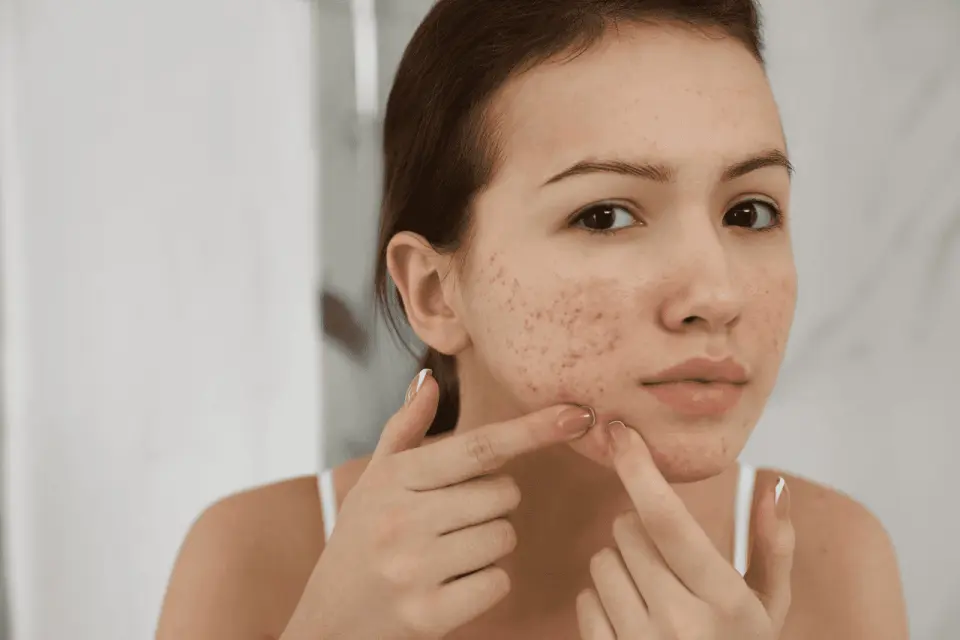 Why Is My Acne So Itchy?