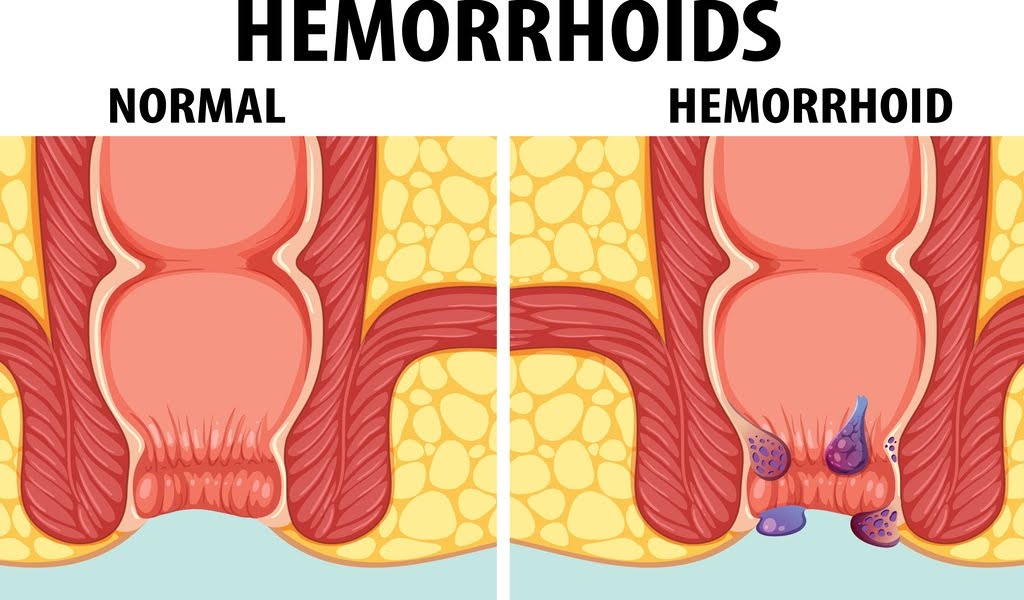 Normal Anus vs Hemorrhoids: What You Should Know (2026)